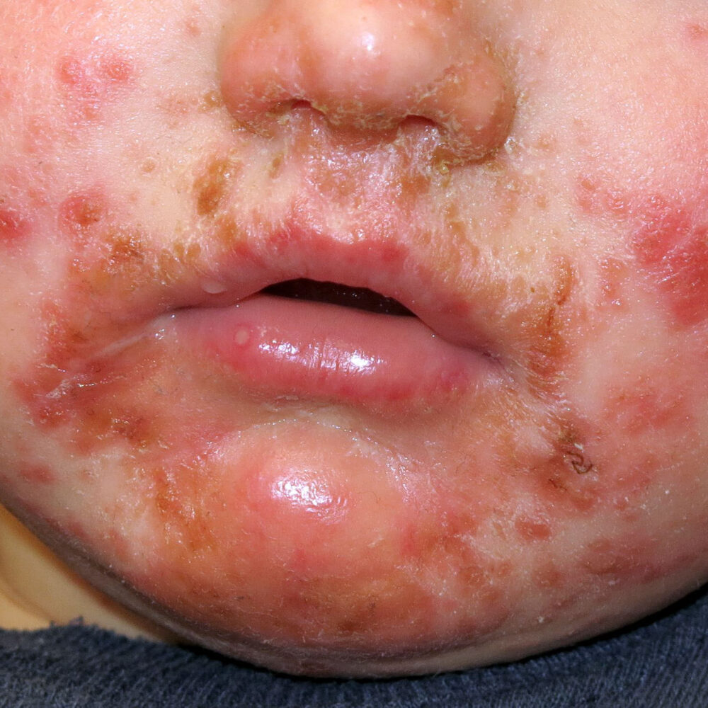 IMPETIGO